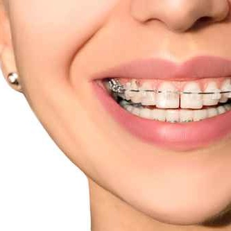 Ceramic Dental Braces Teeth Female Smile