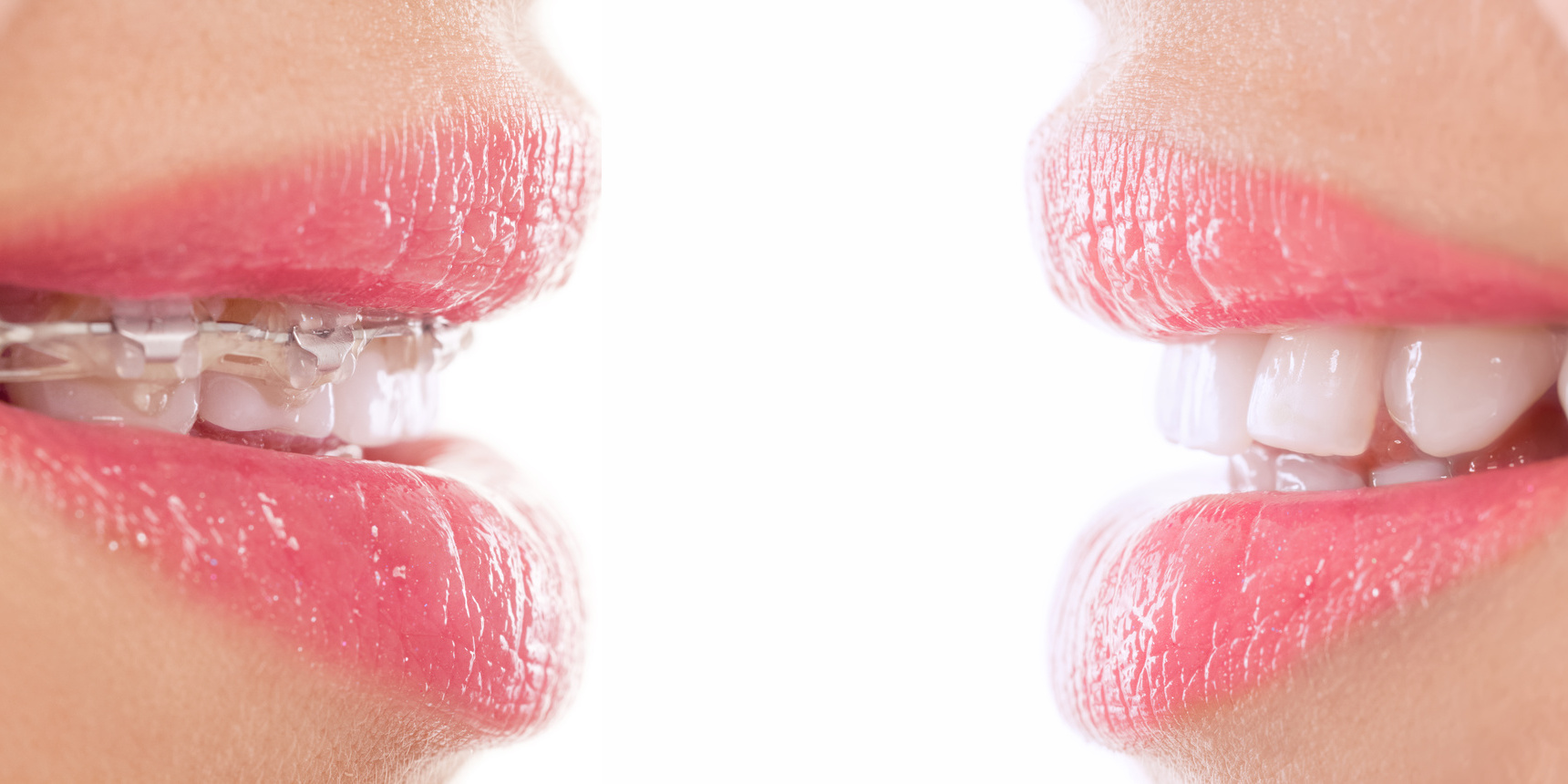 Healthy happy smile with braces before and after